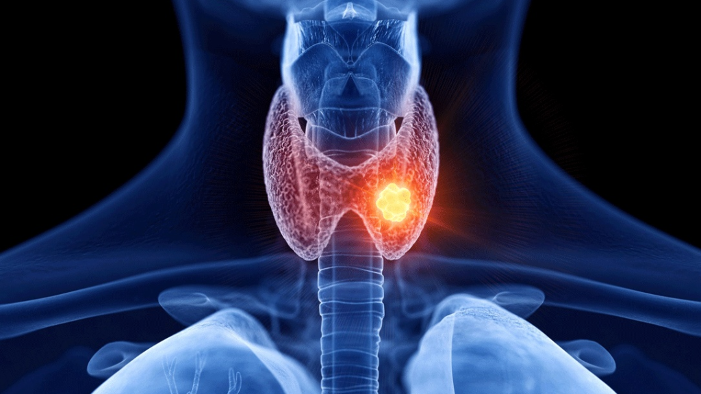 Câncer de Tireoide: 5 Sinais de Alerta, Diagnóstico e Tratamento