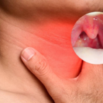 Abscesso Periamigdaliano: 5 Sintomas, Riscos e Tratamento Urgente